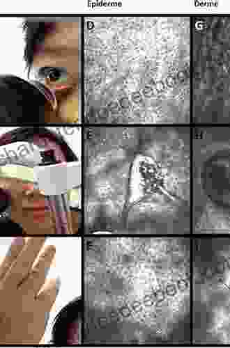 Eyelid And Conjunctival Tumors: In Vivo Confocal Microscopy